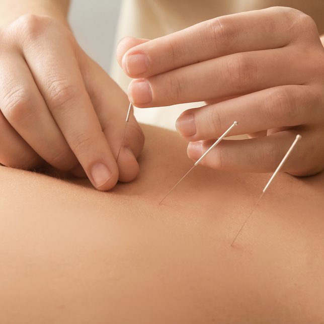 Young man getting acupuncture treatment, closeup