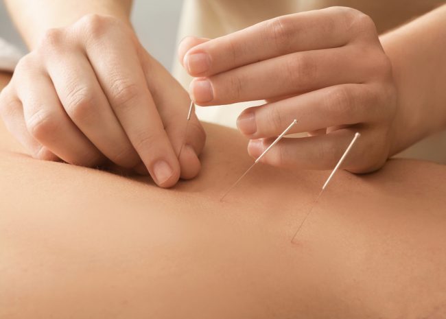 Young man getting acupuncture treatment, closeup