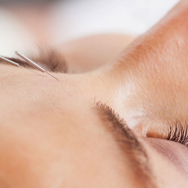 cosmetic-acupuncture cosmetic acupuncture