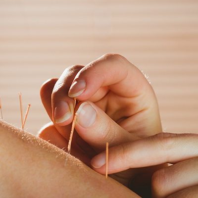 Sports acupuncture